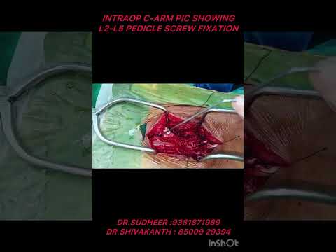 Lumbar stenosis+Migrated Disc |Decompression&amp;TLIF | Dr.Sudheer Pothu| Best Spine Surgeon |Hyderabad