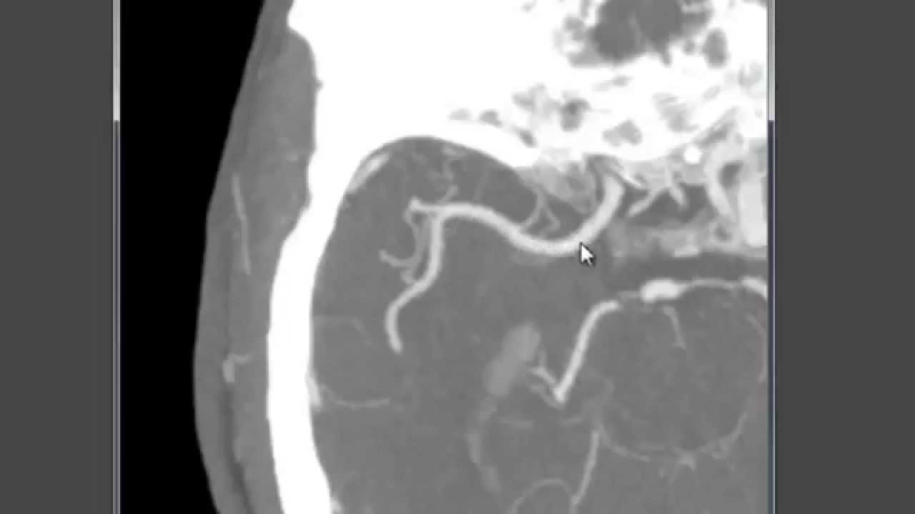 MCA named segments - M1 etc