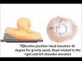 Caudate Cavernous Malformation Resection: Gravity-Assisted Transcallosal Approach. Dr. Gaousul Azam