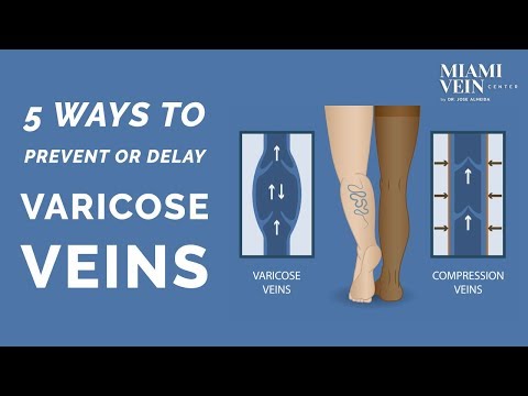 5 Ways to Prevent Varicose Veins or Keep Existing Varicose Veins from Getting Worse