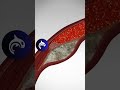 See What A Heart Attack Looks Like In Your Body 3D Animation Heart Heartattack Hearthealth