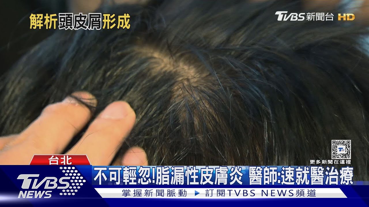 脂漏性皮膚炎導致「這部位」發炎角質異常剝落 醫:速就醫治療!
