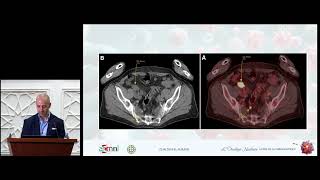 Avis du Médecin Nucléaire : Cancer Colo Rectal (Dr E/K ATTIA)