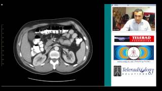 preview picture of video 'CT of Perforated Sigmoid Diverticulitis by Dr Arjun Kalyanpur'