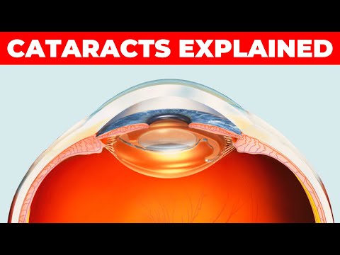 Cataracts Explained Simply: What is it, Causes, Symptoms, Diagnosis & Treatment