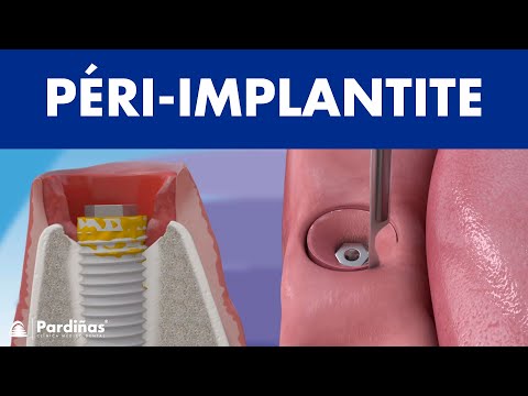 La péri-implantite ©
