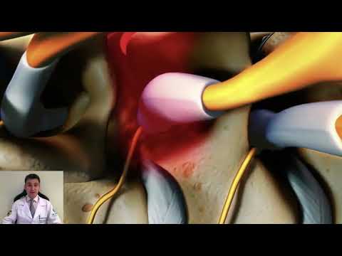O que é Artrose (Desgaste) da Coluna Cervical