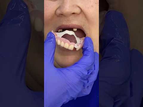 Flexible dentures. How to fix a dentures? #dentures