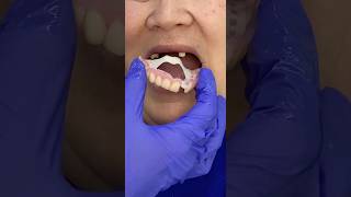 Download lagu Flexible dentures. How to fix a dentures? #dentures mp3