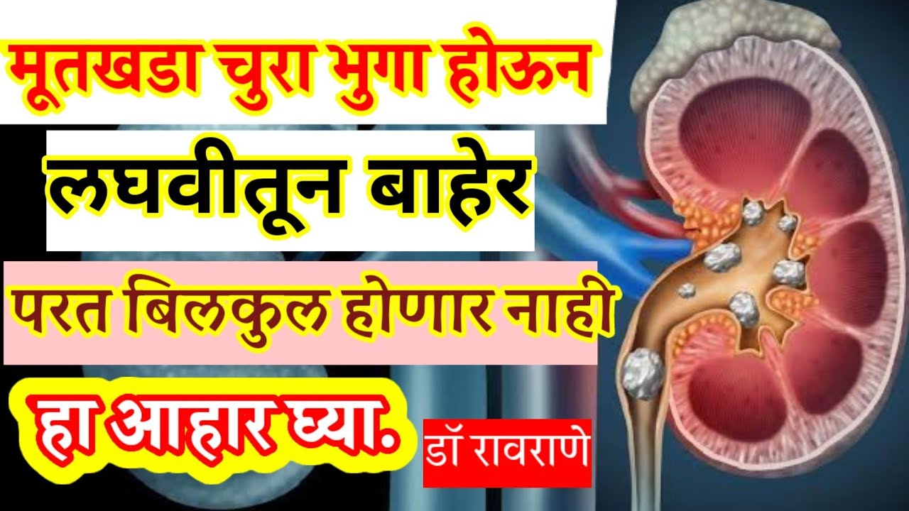 हा आहार घ्या मूतखडा KIDNEYSTONE विरघळायलाच पाहिजे. Diet in Kidney Stone #kidney_stone