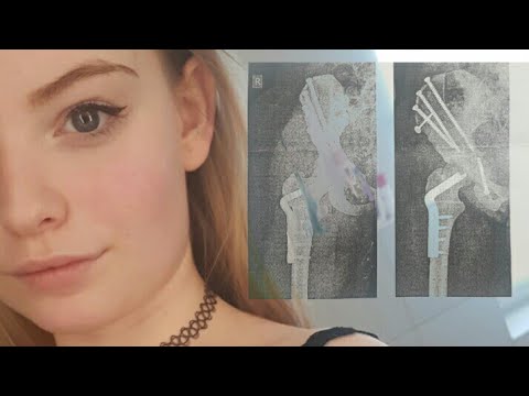 Storytime| 3 mal die Hüfte gebrochen | Fitness.Lifestyle.Beauty