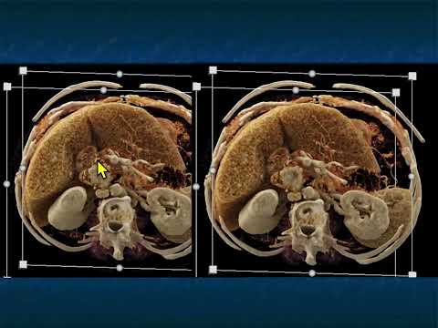 CT Evaluation of Small Bowel Obstruction: Pearls and Pitfalls in Clinical Practice - Part 1