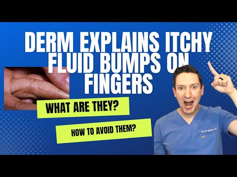 Do you have ITCHY, FLUID, LITTLE BUMPS on your HANDS OR FEET? Derm explains Dyshidrotic Eczema
