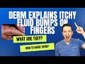 Do you have ITCHY, FLUID, LITTLE BUMPS on your HANDS OR FEET? Derm explains Dyshidrotic Eczema