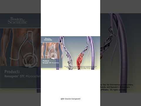 Non-surgical treatment of Varicocele (3D animation) | Varicocele embolization | by Dr. Gaurav G.