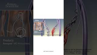 Download lagu Non-surgical treatment of Varicocele (3D animation) | Varicocele embolization | by Dr. Gaurav G. mp3