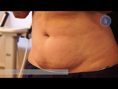 Coolscuplting Elite para Abdomen