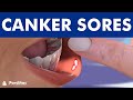 CANKER SORE Treatment And Mouth Ulcer Causes