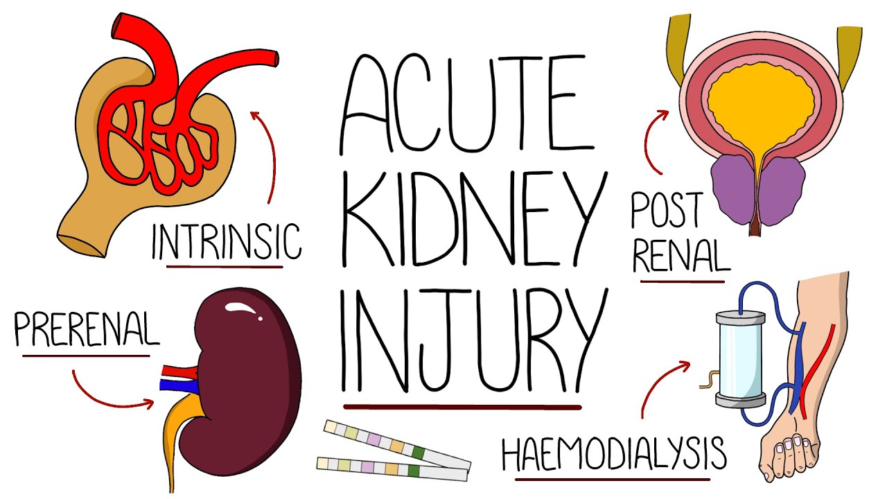 Understanding Acute Kidney Injury (AKI Made Easy)