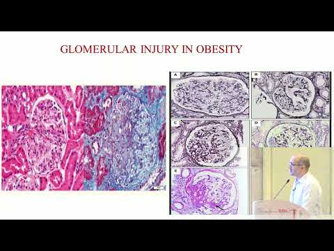 Kidney Disease associated with obesity, Dr  Hamad Jeelani  Oman