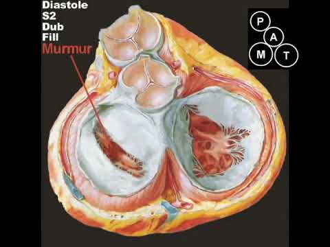 7. mitral stenosis ..Animated Mitral Stenosis Murmur