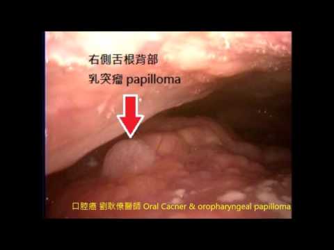 , title : '(口腔)牙齦癌與口咽乳突瘤 Lower Gum Cancer & Papilloma of Tongue Base. Dr.  Ken-Liao Liu'