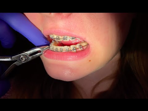 Regular Braces Check ups 18 by 25 Ni Ti Wire - Tooth Time Family Dentistry New Braunfels