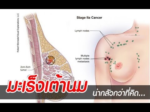 หน้าอกเล็กเป็นพยาธิวิทยา ไม่ว่าจะเป็นไปได้ที่จะเพิ่มหน้าอกกับโรคเต้านมอักเสบ