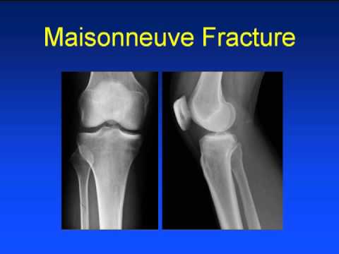 Ankle Trauma Advanced Anatomy, Imaging & Classification
