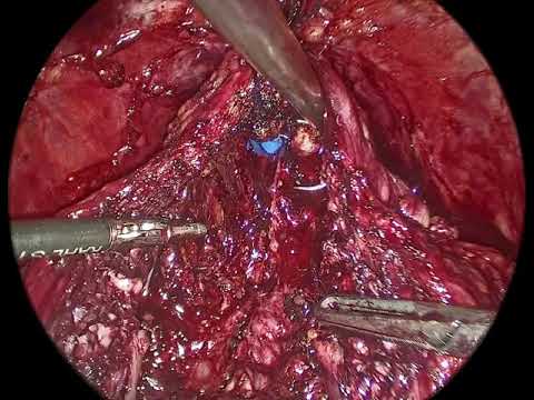 Laparoscopic Adenomectomy