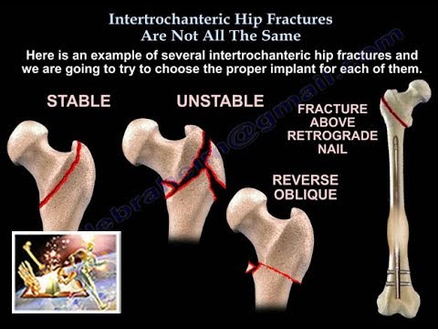 Intertrochanteric Hip Fractures , not the Same - Everything You Need To Know - Dr. Nabil Ebraheim