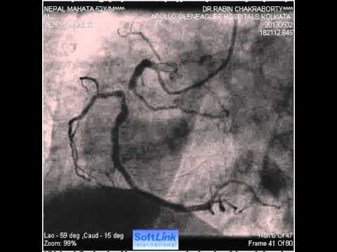 (BVS) Bifurcation Transdial 1