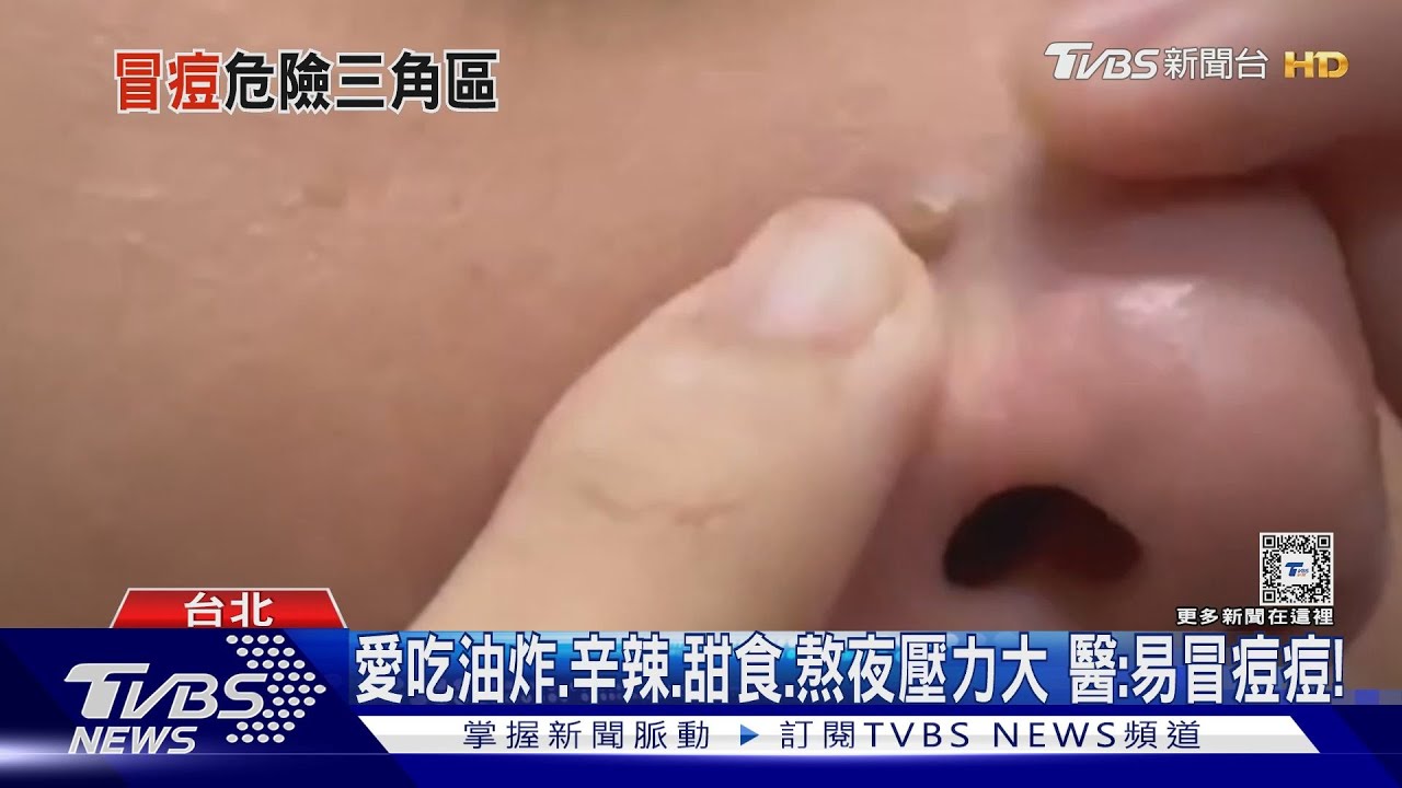 臉部「危險三角區」冒出痘痘　做「這件事」感染後、下場慘！