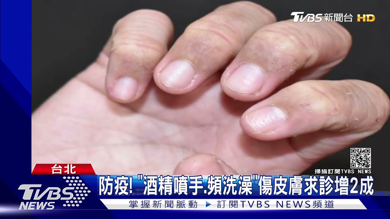 防疫!「酒精噴手、頻洗澡」 傷皮膚求診增2成