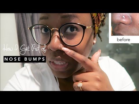 HOW TO GET RID OF A NOSE PIERCING BUMP/ KELOID...