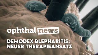 Demodex Blepharitis: Neuer Therapieansatz – OphthalNews | 07.12.2022
