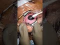 EPI Contoura Eye Treatment Eye Eyehospital Eyesurgery Contoura Epicontoura Contourasurgery