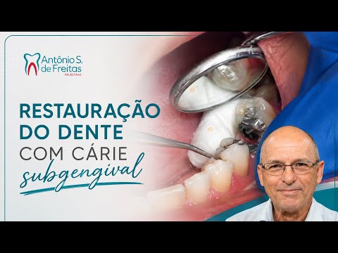 Restauração do dente com cárie subgengival devido ao mal uso do fio dental. Dr Antônio Sérgio 
