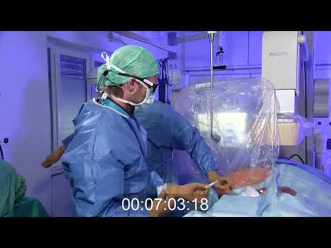 Transkatheter edge-to-edge repair (TEER) mit PASCAL Precision bei hochgradiger Mitralinsuffizienz