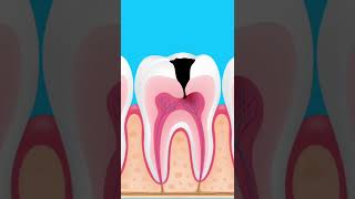 What happens if tooth decay is left untreated