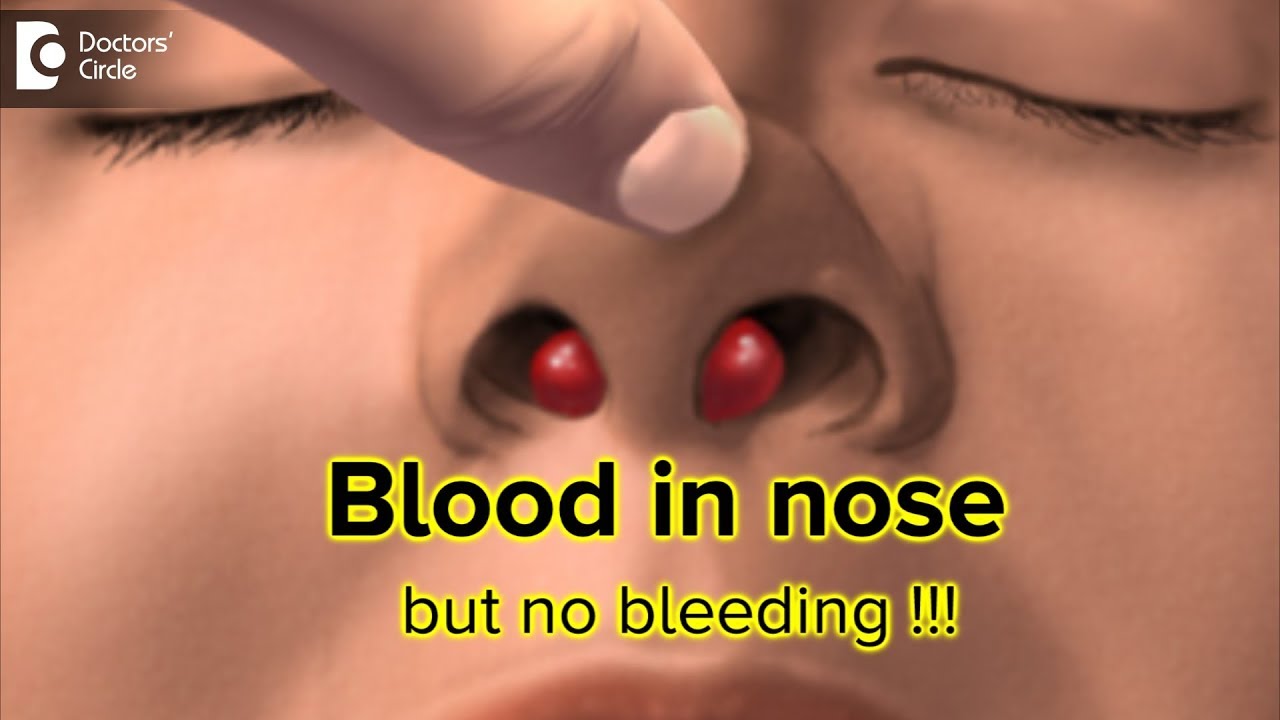Why did a lump of blood come out of my nose? Tipseri