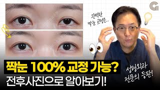 짝눈 100% 교정이 가능할까?