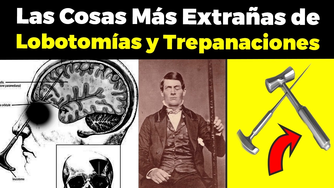 Las Cosas Más Extrañas de Lobotomías, Trepanaciones y la Medicina