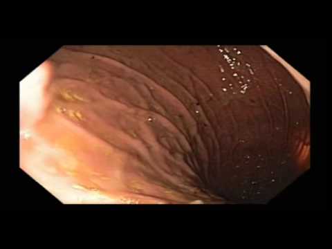 Gastric Gastrointestinal Stromal Cell Tumor (GIST)