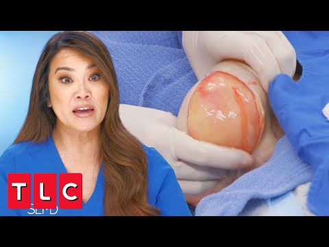 This Lipoma Is in “One of the Worst Possible Places” | Dr. Pimple Popper