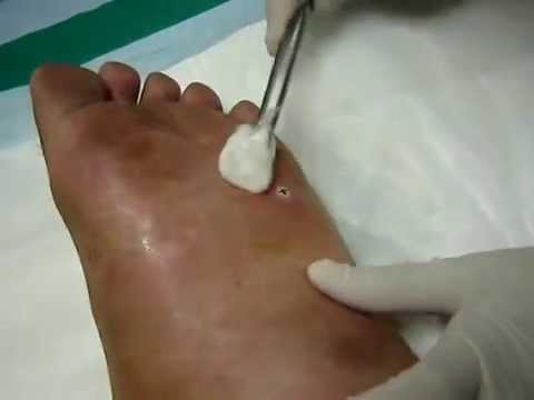 อาการกำเริบฤดูกาลของโรคสะเก็ดเงิน ดูเหมือนว่า neurodermatitis ในภาพเด็ก