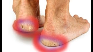 How to Repair Cracked And Dried Feet At Home Fast - Dry Cracked Heels Treatment