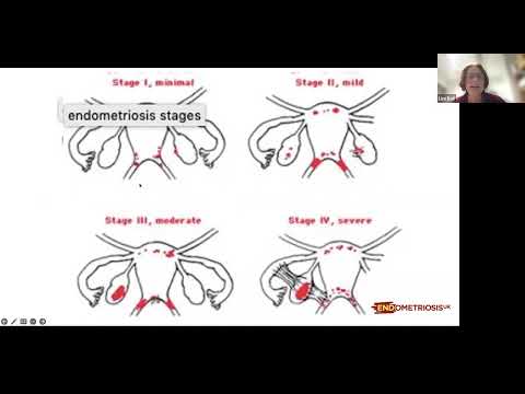 Surgery and why some may need more than one webinar