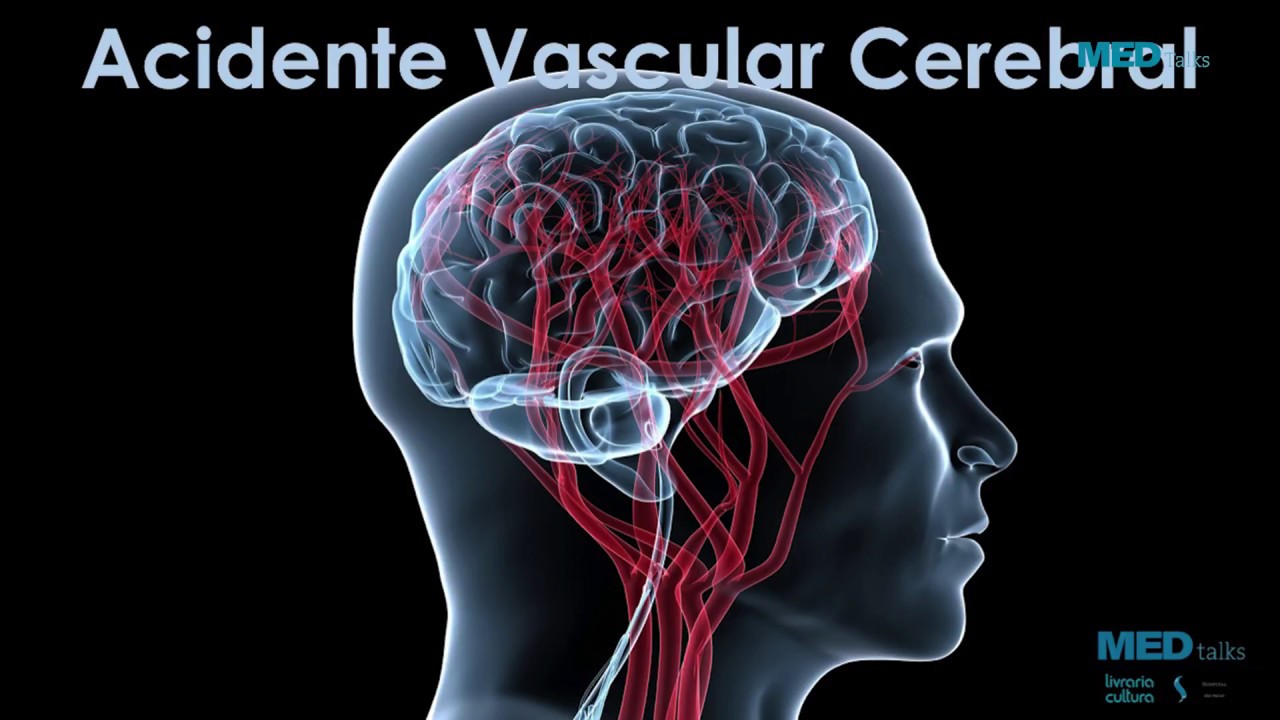 Acidente Vascular Cerebral Isquêmico – Dr. Rafael Waanabe
