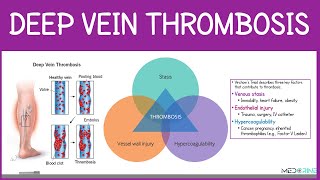 Deep Vein Thrombosis (DVT) and Deep Vein Thrombophlebitis Simplified